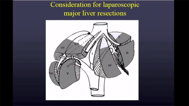 Video Thumbnail: Surgical Treatment of Colorectal Cancer Metastasis to the Liver