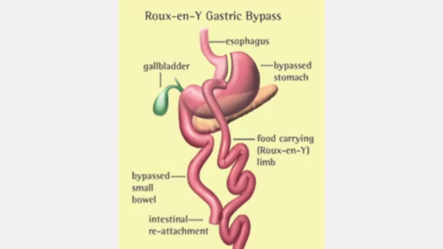 Video Thumbnail: Gastric Bypass Surgery 