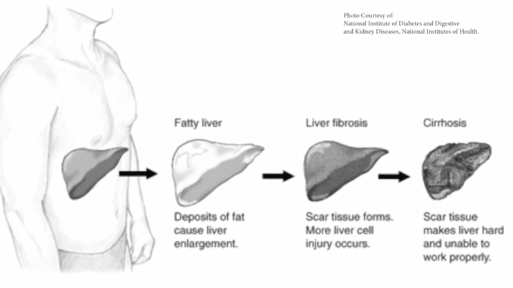 Video Thumbnail: Liver Disease – Fibrosis