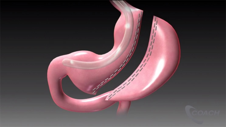 Video Thumbnail: Sleeve Gastrectomy