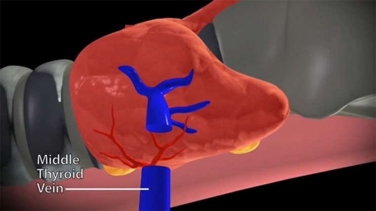 Video Thumbnail: Minimally Invasive Total Thyroidectomy